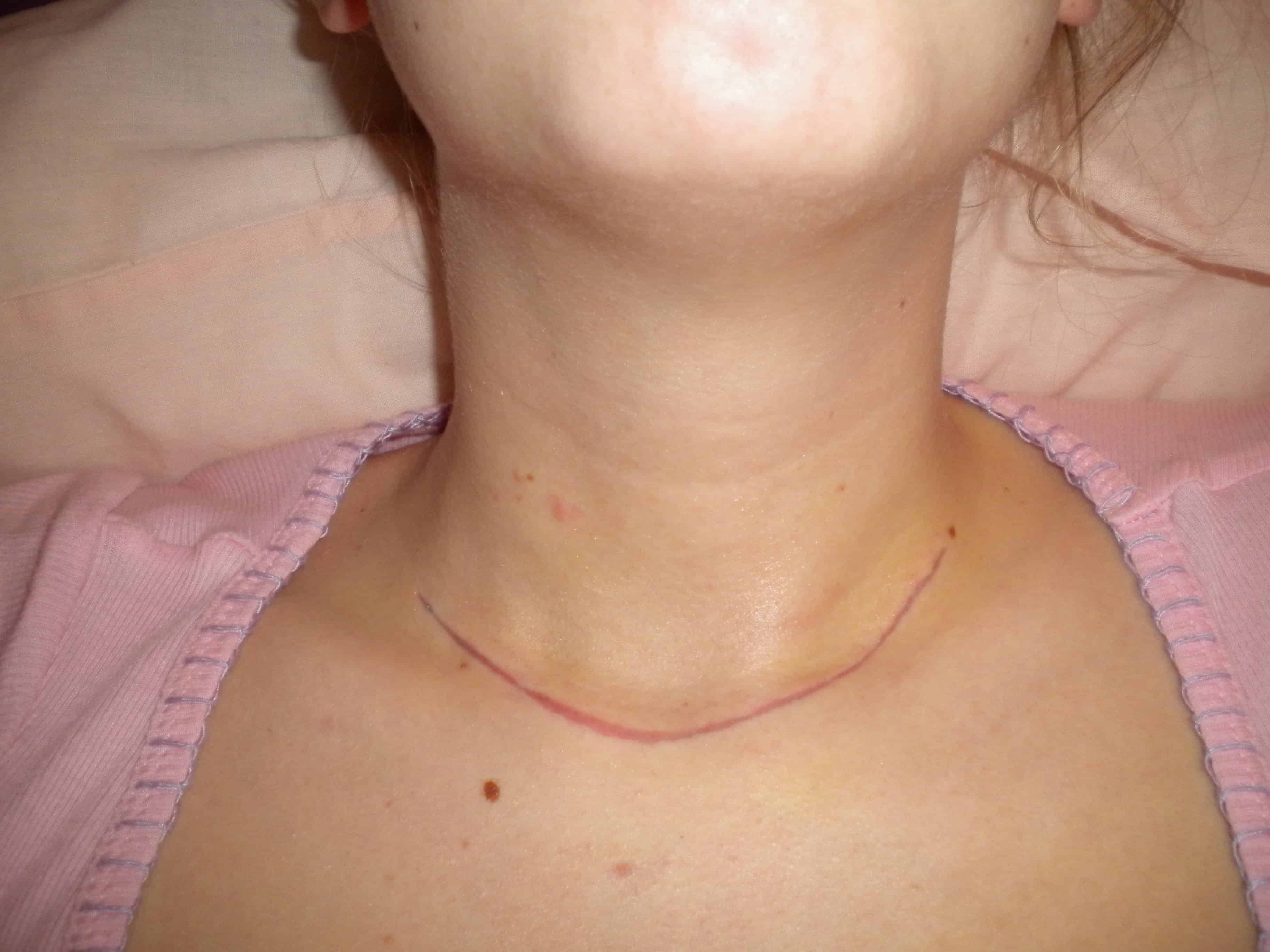 Nice necklaces that can cover a thyroid scar? (NWR)
