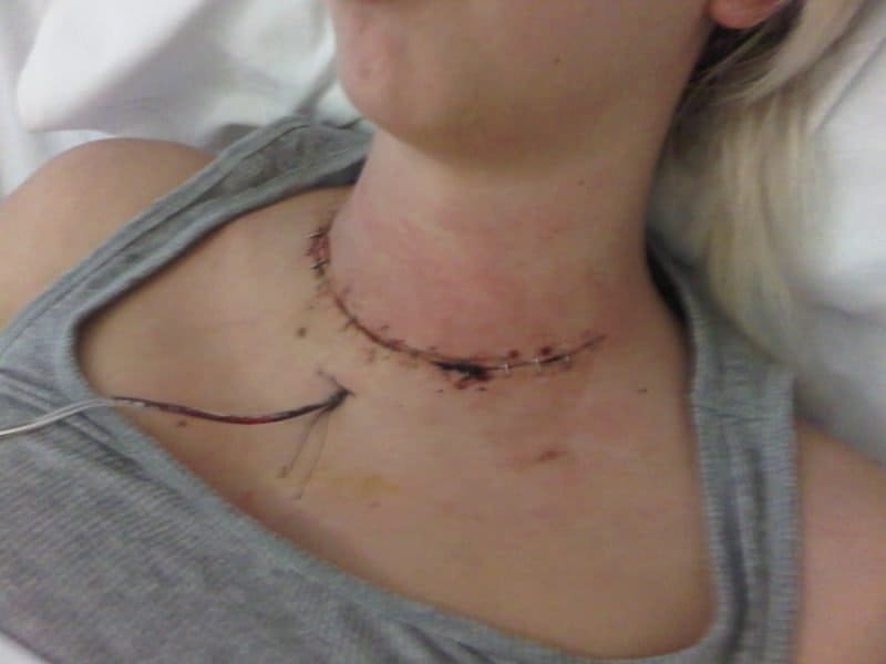 My thyroidectomy experience: www.theglutenfreeblogger.com