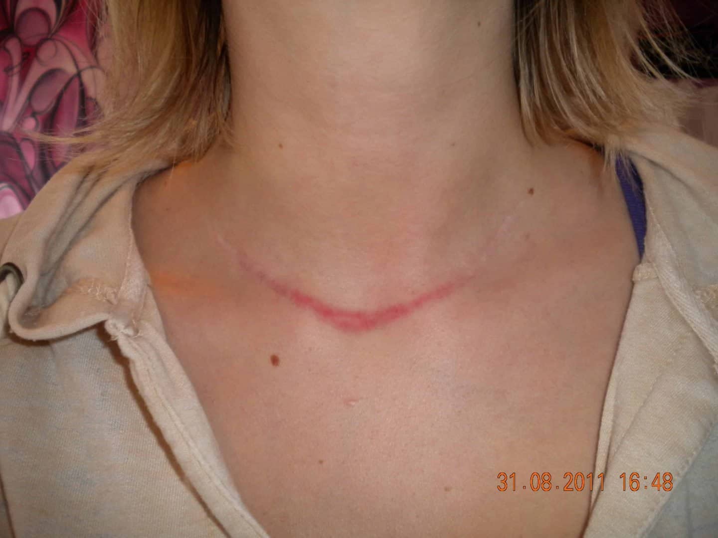 Nine months after thryoidectomy